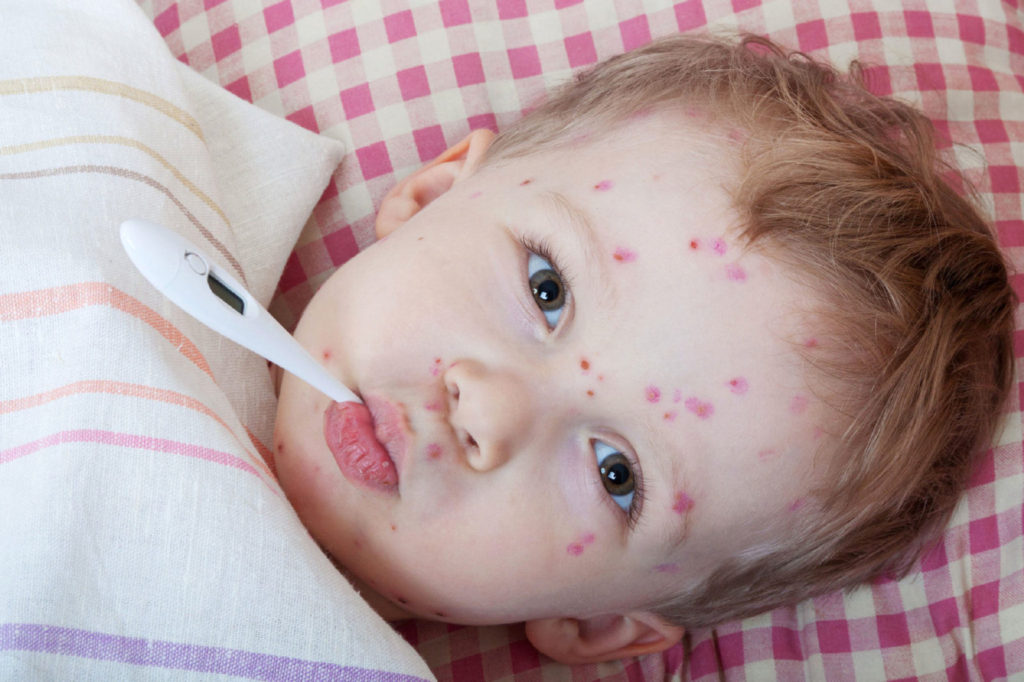 measles in children