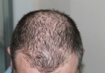 Medications That Might Cause Hair Loss: Top 5 Pharmaceuticals to Avoid
