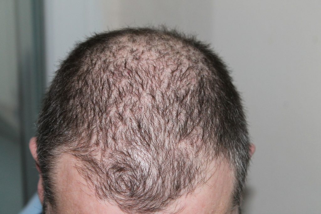 medications that cause hair loss